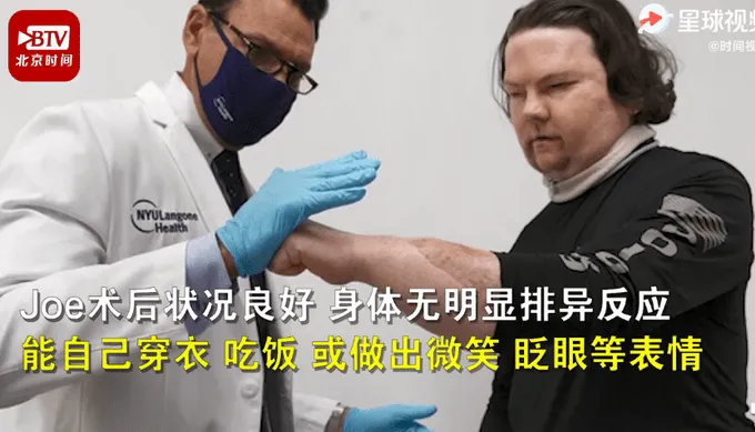 全球首例成功换脸换手手术什么情况