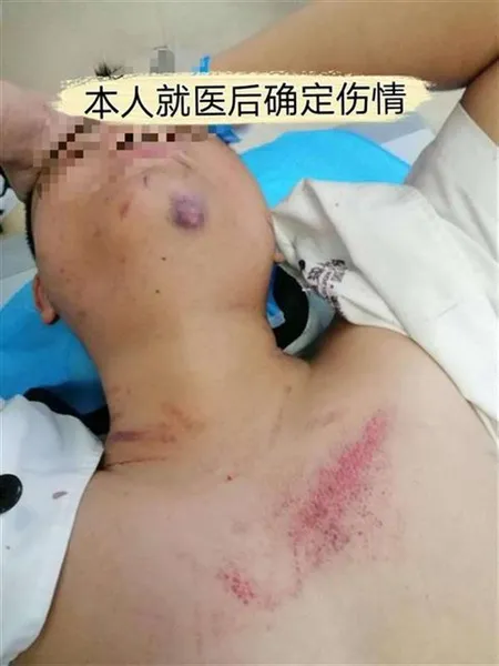 男子要求更换商品被打断12根骨头什